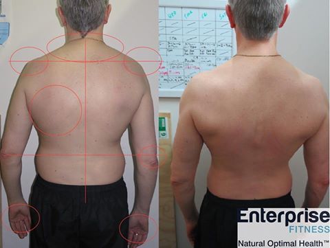 Chronic Back Pain Scoliosis 